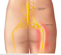 Download Sciatic nerve pain pictures 237 images62