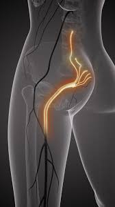 Download Sciatic nerve pain pictures 341 images66