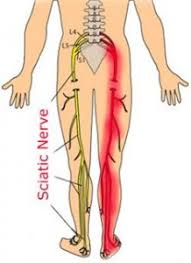 Download Sciatic nerve pain pictures 279 images67