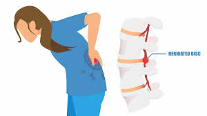 Download Sciatic nerve pain pictures 339 images68