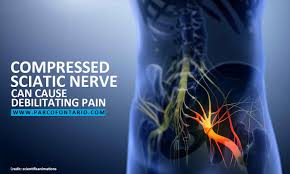 Download Sciatic nerve pain pictures 224 images7