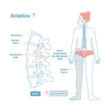 Download Sciatic nerve pain pictures 359 images72