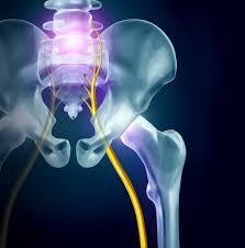 Download Sciatic nerve pain pictures 312 images76