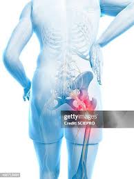 Download Sciatic nerve pain pictures 314 images79