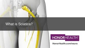 Download Sciatic nerve pain pictures 316 images82