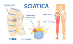 Download Sciatic nerve pain pictures 202 images87