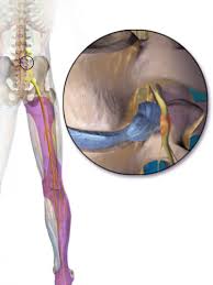 Download Sciatic nerve pain pictures 338 images99