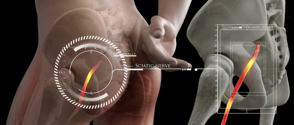Download Sciatic nerve pain pictures 22 low back pain blog image 02