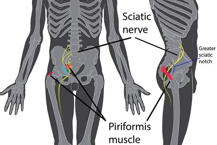 Download Sciatic nerve pain pictures 69 montreal Sciatic Nerve treatment