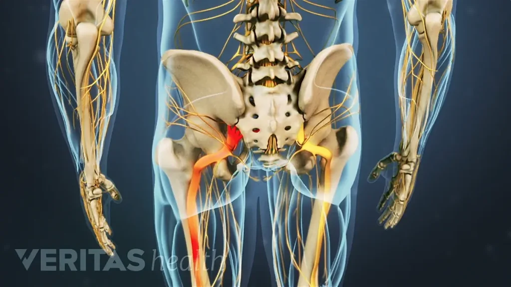 Download Sciatic nerve pain pictures 63 radiating pain sciatic nerve