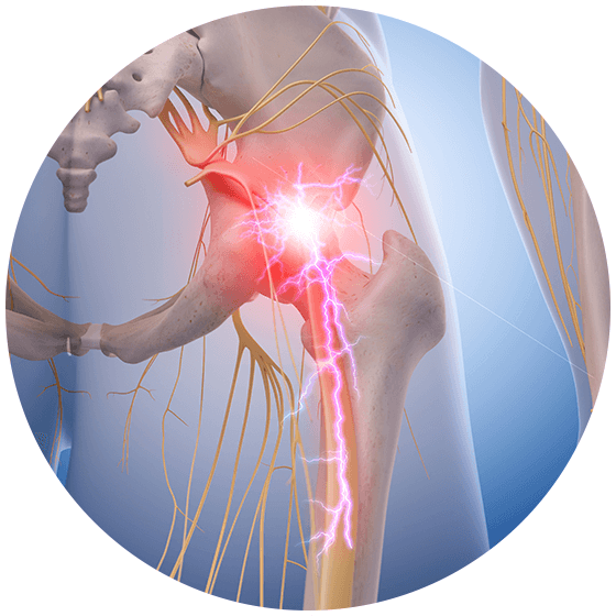 Download Sciatic nerve pain pictures 35 sciatia