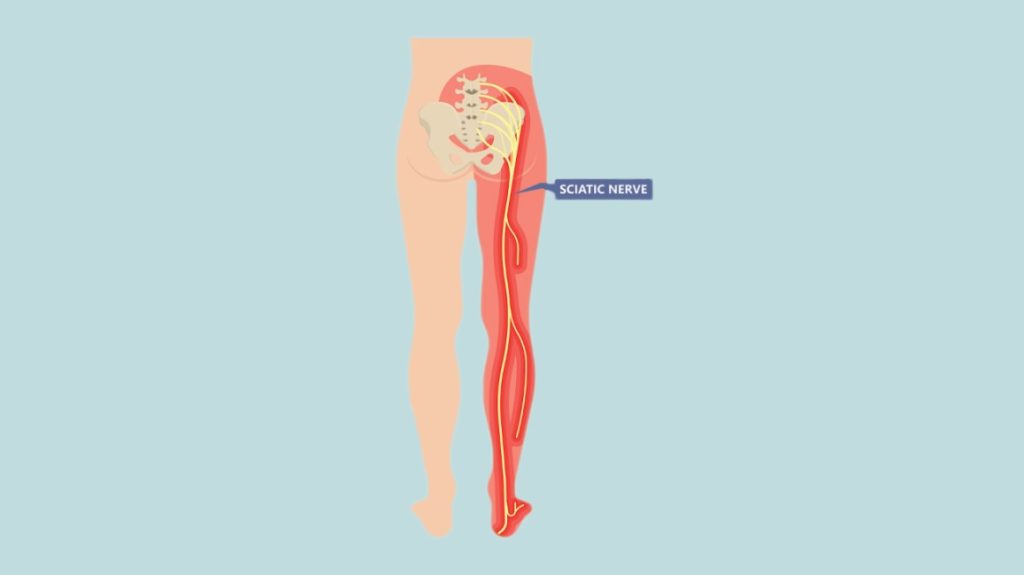Download Sciatic nerve pain pictures 89 sciatic nerve header