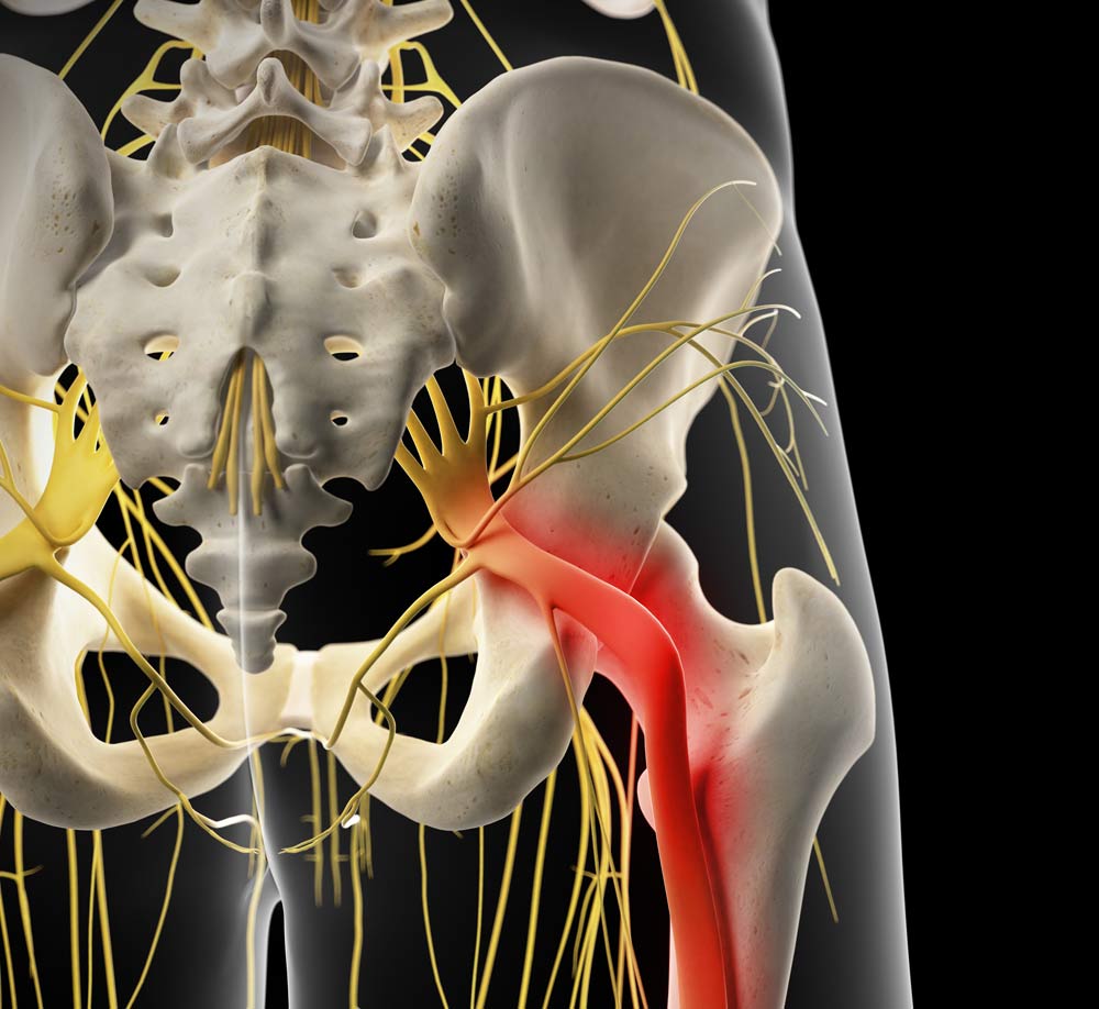 Download Sciatic nerve pain pictures 34 sciatic nerve pain 1
