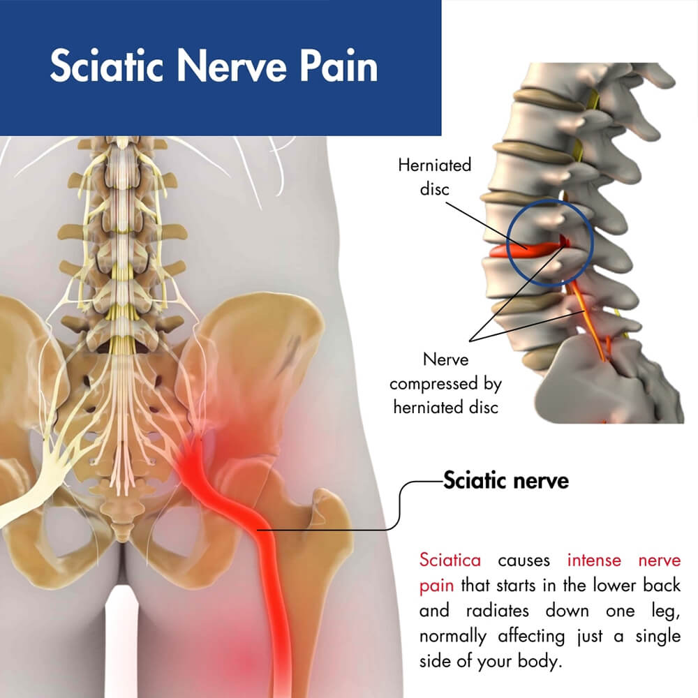 Download Sciatic nerve pain pictures 40 sciatic nerve pain2