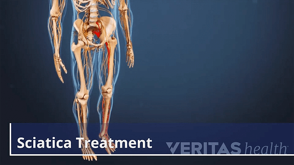 Download Sciatic nerve pain pictures 54 sciatica 1