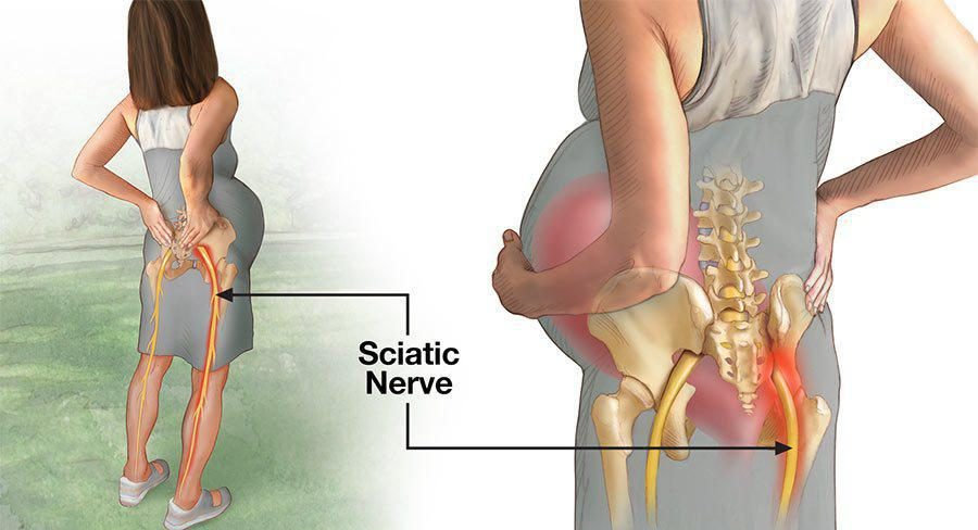 Download Sciatic nerve pain pictures 52 sciatica 5