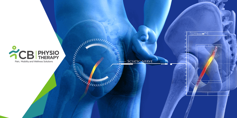 Download Sciatic nerve pain pictures 33 sciatica how physiotherapy management helps in relieving the sciatic nerve pain