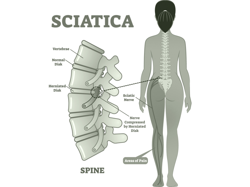 Download Sciatic nerve pain pictures 38 sciatica nerve pain