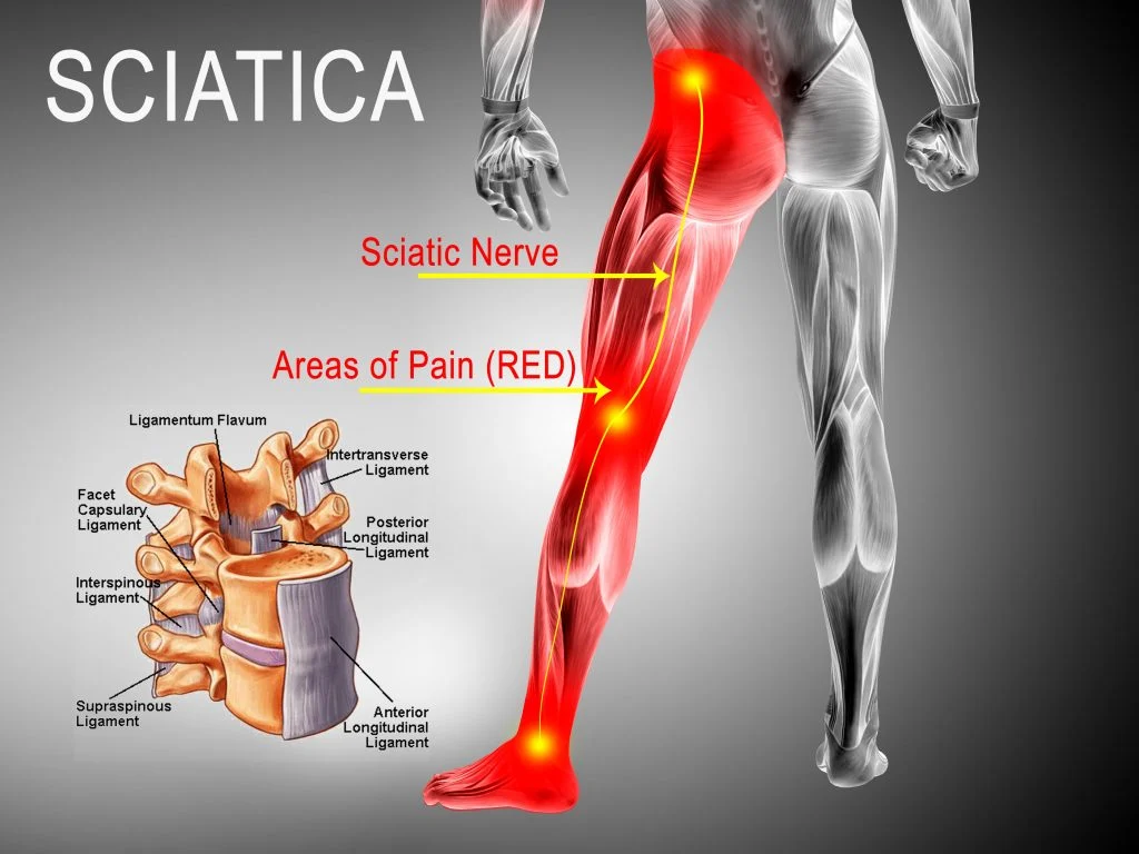 Download Sciatic nerve pain pictures 53 sciatica pain colorado pain care blog