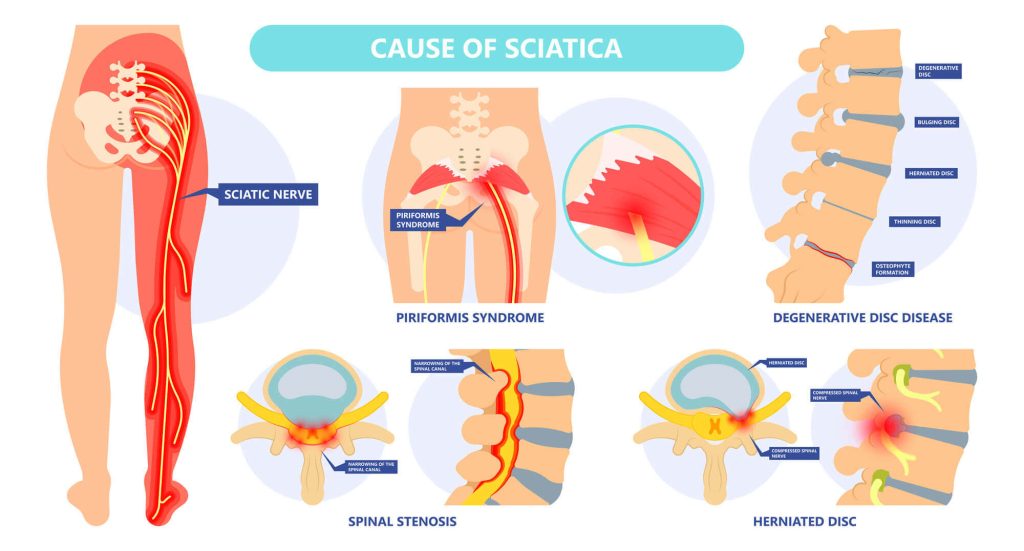 Download Sciatic nerve pain pictures 20 sciatica pain relief with chiropractic asfca olathe ks