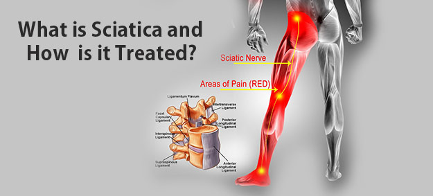 Download Sciatic nerve pain pictures 81 sciatica pain treatment