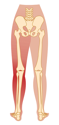Download Sciatic nerve pain pictures 93 sciatica sciaitic pain Bodytonic clinic London
