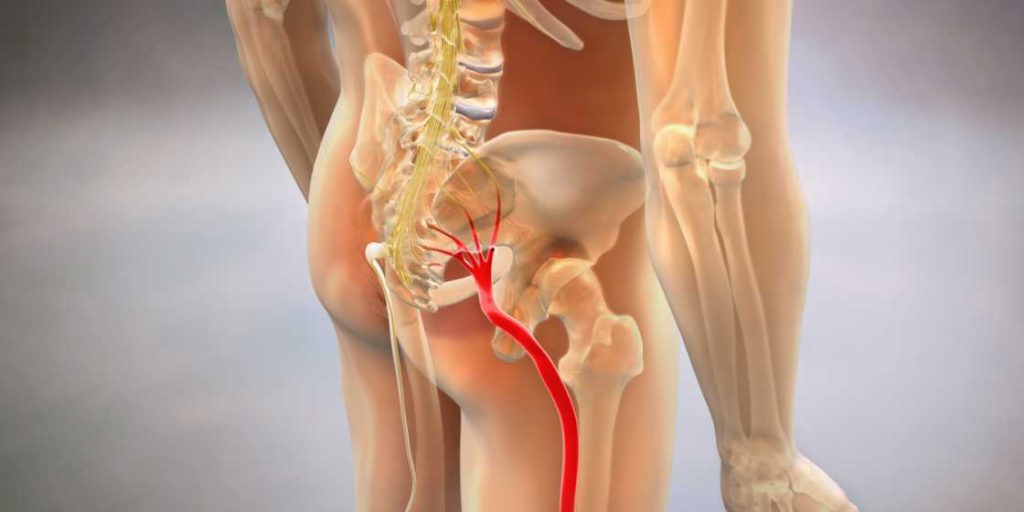 Download Sciatic nerve pain pictures 73 sciatica surgery 1024x512 1