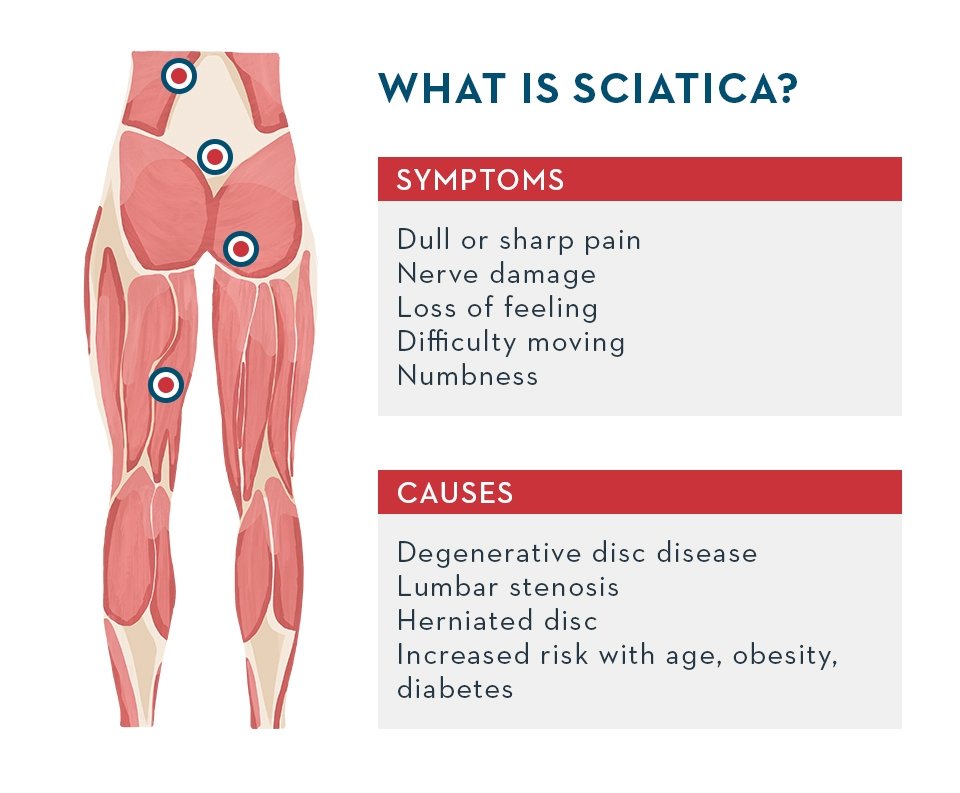 Download Sciatic nerve pain pictures 49 sciatica
