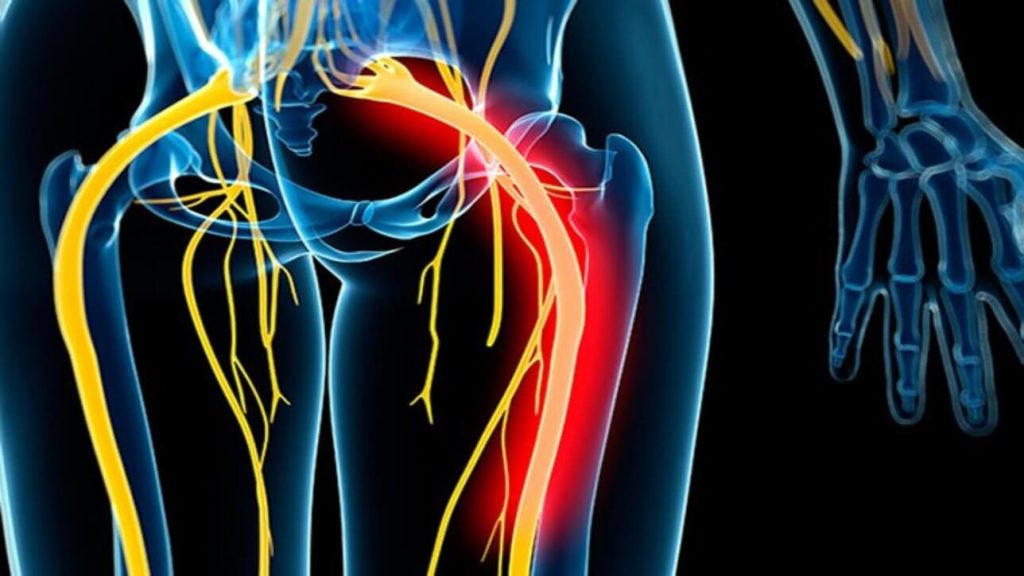 Download Sciatic nerve pain pictures 47 sciatica1 1288x724 1