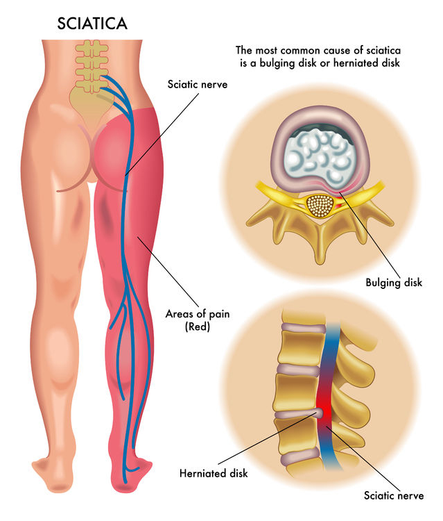 Download Sciatic nerve pain pictures 19 sciatica23117022 m