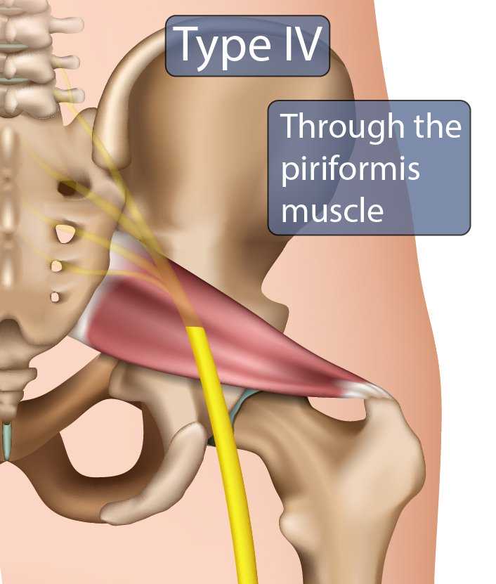 Download Sciatic nerve pain pictures 77 type iv sciatic nerve.jpg 706.0x831.0 q85 subject location 3532C414 subsampling 2